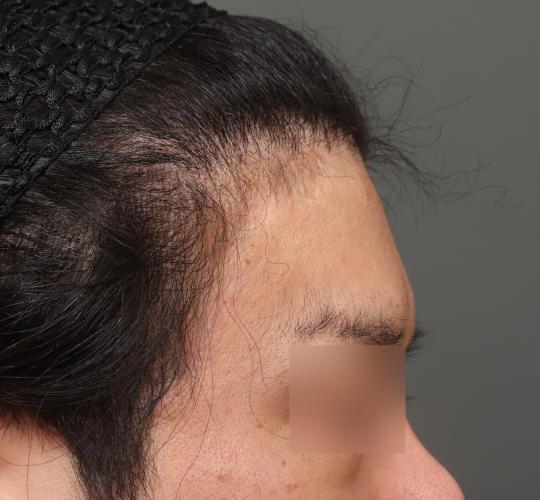 30代男性の生え際前進術 After 症例写真