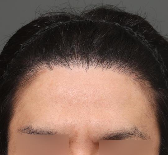 30代男性のエラ・アゴ・小顔 Before 症例写真