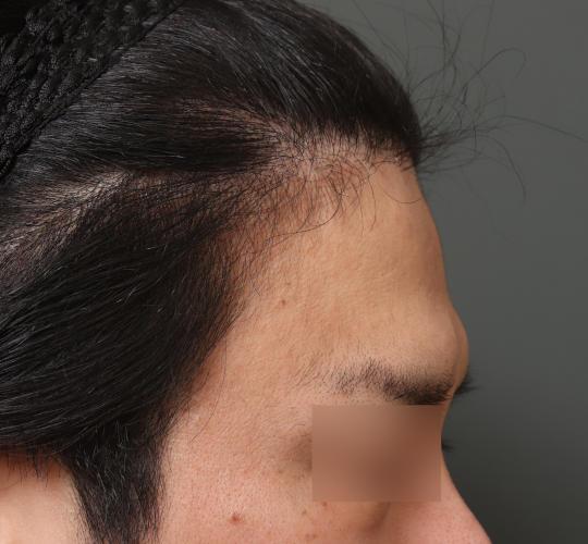 30代男性の生え際前進術 Before 症例写真