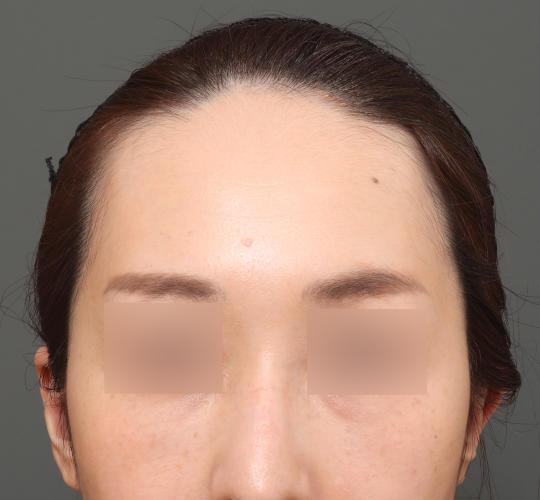 30代女性のエラ・アゴ・小顔 Before 症例写真