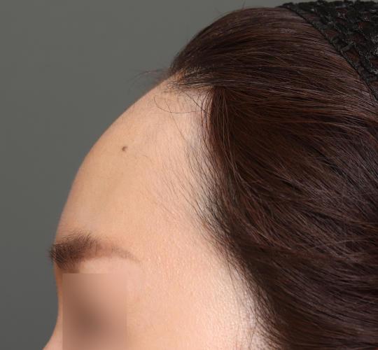 30代女性の額縮小 Before 症例写真