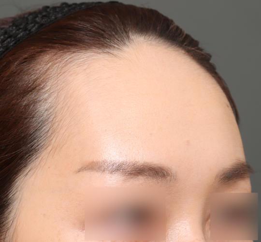 30代女性の額縮小 Before 症例写真