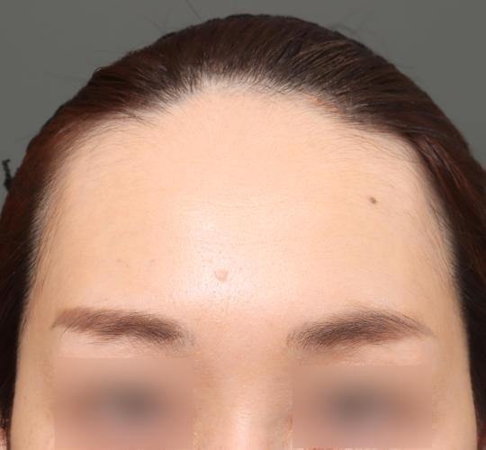 30代女性の額縮小 Before 症例写真