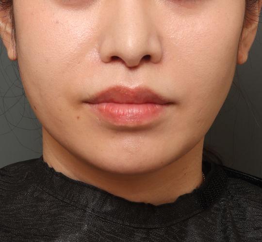 30代女性の鼻の整形 After 症例写真