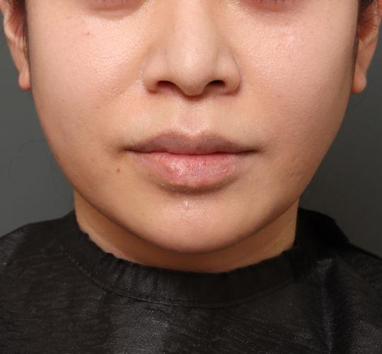 30代女性の鼻の整形 Before 症例写真