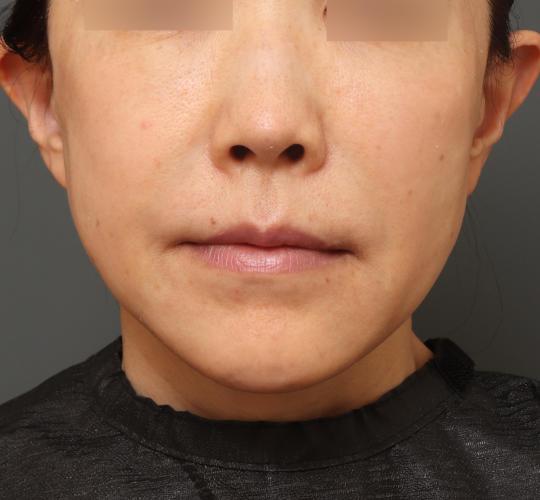 50代女性の耳介軟骨移植 After 症例写真