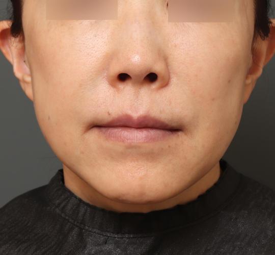 50代女性の耳介軟骨移植 Before 症例写真