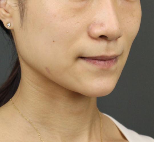 20代女性のシミ・そばかす After 症例写真
