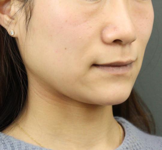 20代女性のシミ・そばかす Before 症例写真