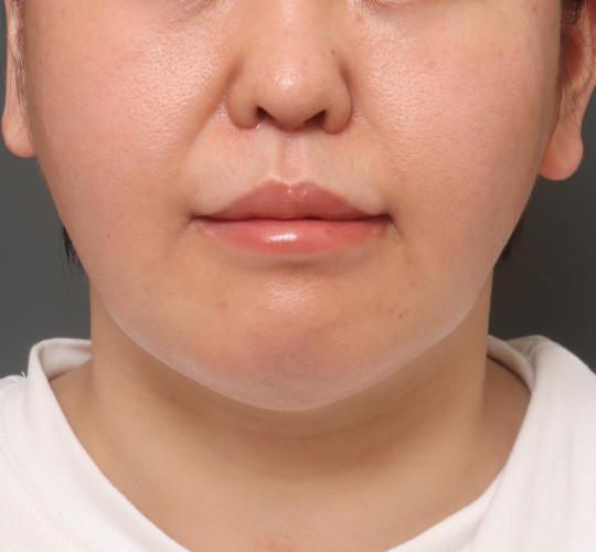 40代女性の鼻の整形 After 症例写真