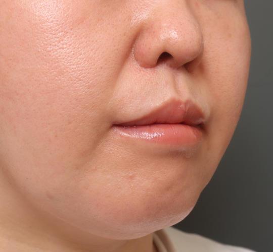 40代女性の鼻翼縮小（小鼻縮小） After 症例写真