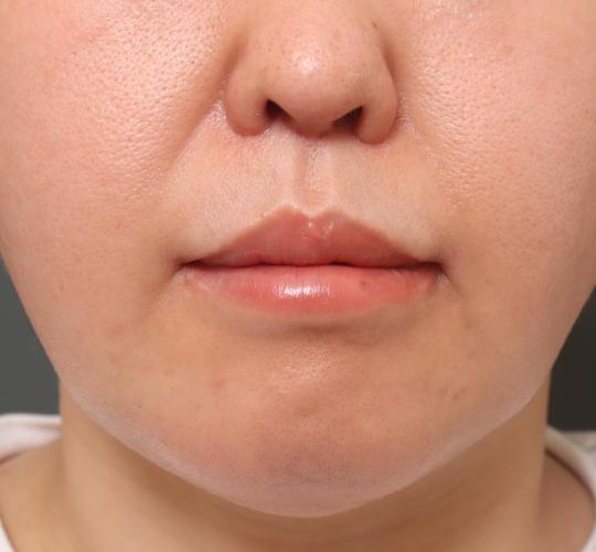 40代女性の鼻翼縮小（小鼻縮小） After 症例写真