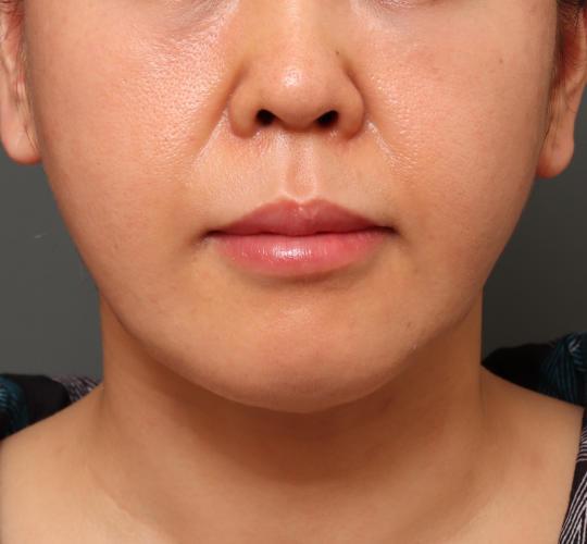 40代女性の鼻の整形 Before 症例写真