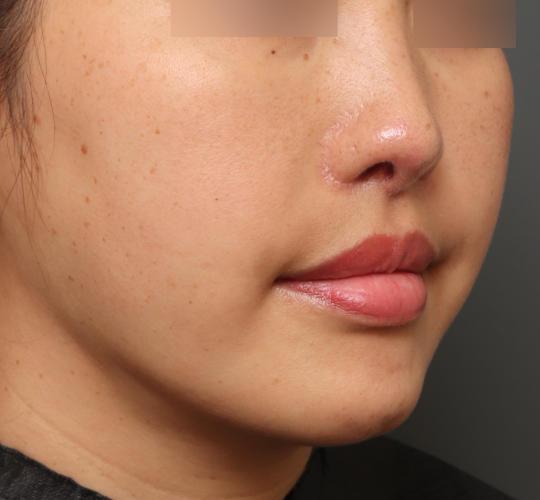 30代女性の鼻の整形 After 症例写真