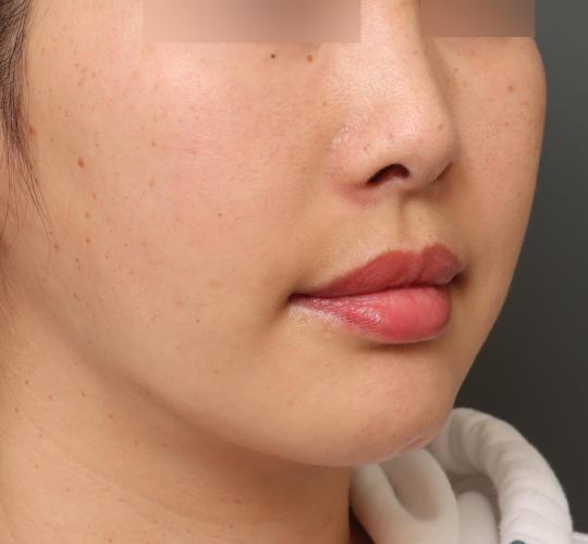 30代女性の鼻の整形 Before 症例写真