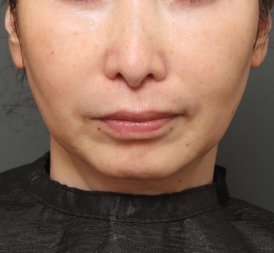 50代女性の鼻の整形 After 症例写真