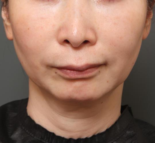 50代女性の鼻の整形 Before 症例写真