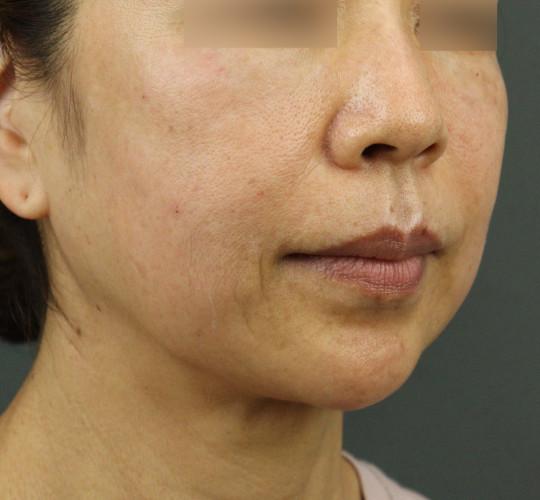 50代女性のヒアルロン酸注射  After 症例写真