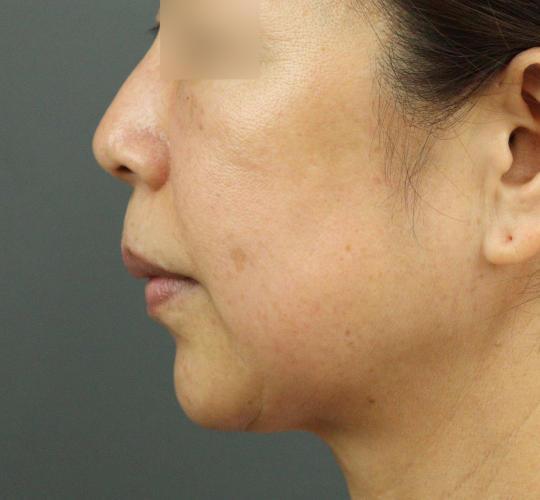 50代女性のヒアルロン酸注射  Before 症例写真