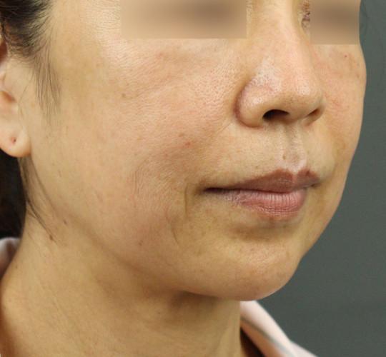 50代女性のヒアルロン酸注射  Before 症例写真