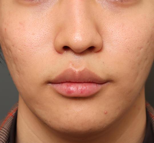 20代男性の人中短縮（リップリフト） After 症例写真