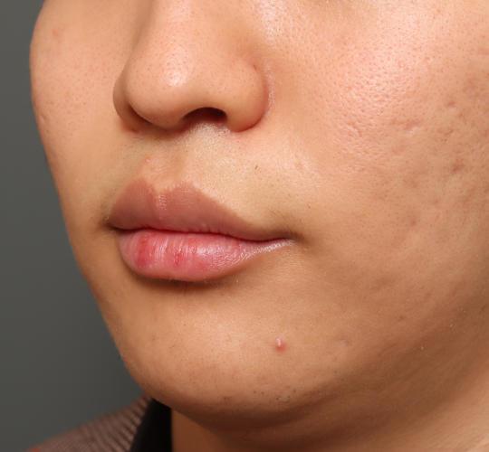 20代男性の人中短縮（リップリフト） After 症例写真
