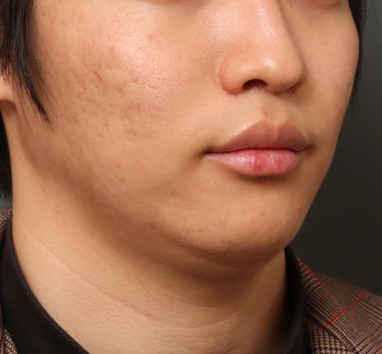 20代男性の人中短縮（リップリフト） After 症例写真