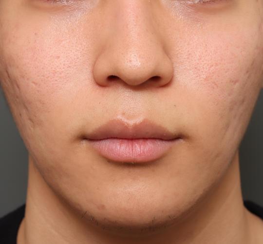 20代男性の人中短縮（リップリフト） Before 症例写真