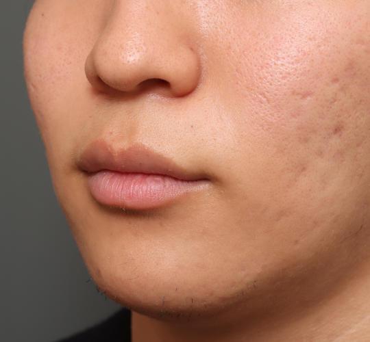 20代男性の人中短縮（リップリフト） Before 症例写真
