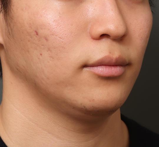 20代男性の人中短縮（リップリフト） Before 症例写真