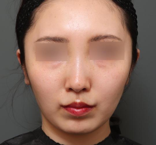 20代女性の人中短縮(リップリフト) After 症例写真