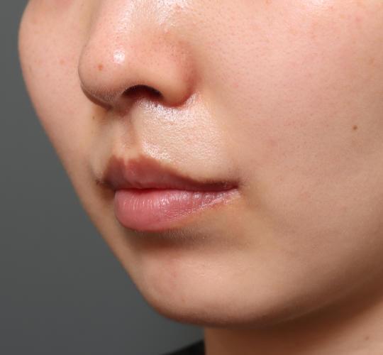 20代女性の人中短縮(リップリフト) After 症例写真