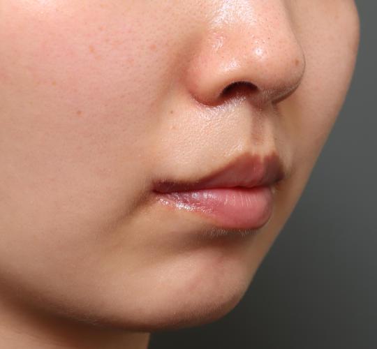 20代女性の人中短縮(リップリフト) After 症例写真