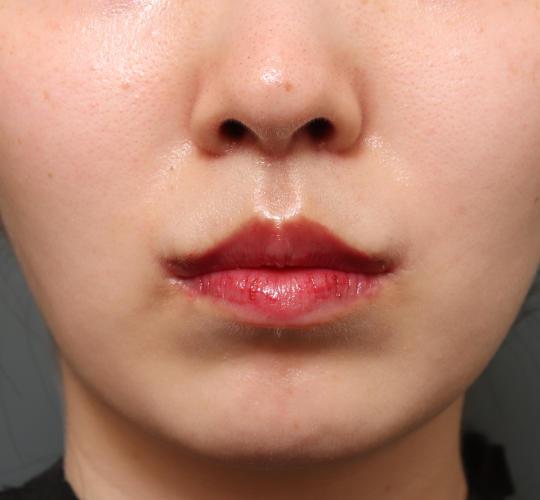 20代女性の人中短縮(リップリフト) After 症例写真
