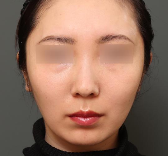 20代女性の人中短縮(リップリフト) Before 症例写真