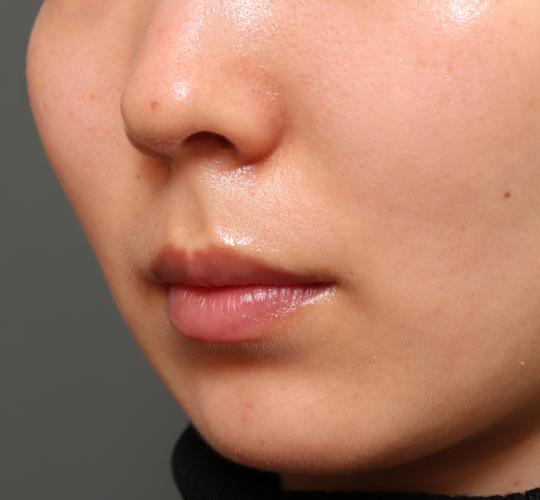 20代女性の人中短縮(リップリフト) Before 症例写真