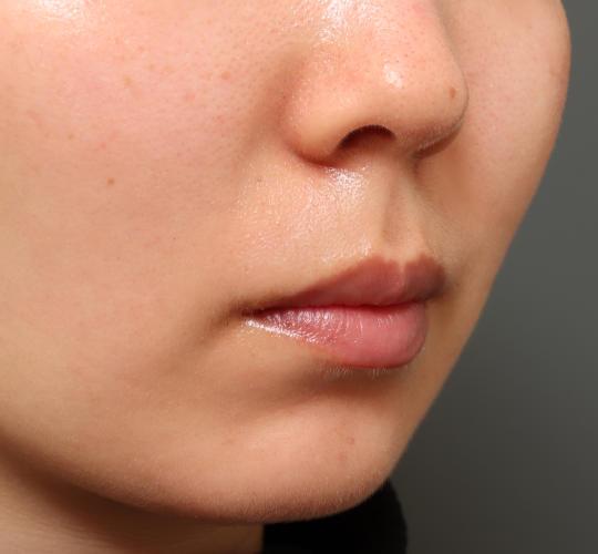 20代女性の人中短縮(リップリフト) Before 症例写真