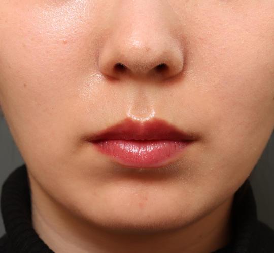 20代女性の人中短縮(リップリフト) Before 症例写真