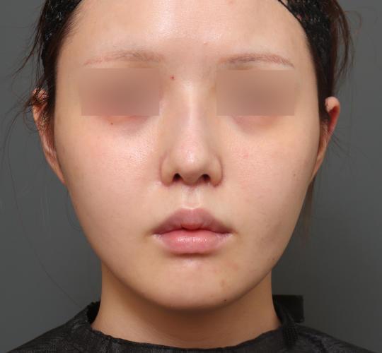 20代女性の人中短縮(リップリフト) After 症例写真