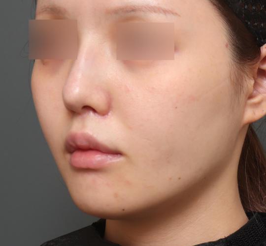 20代女性の人中短縮(リップリフト) After 症例写真