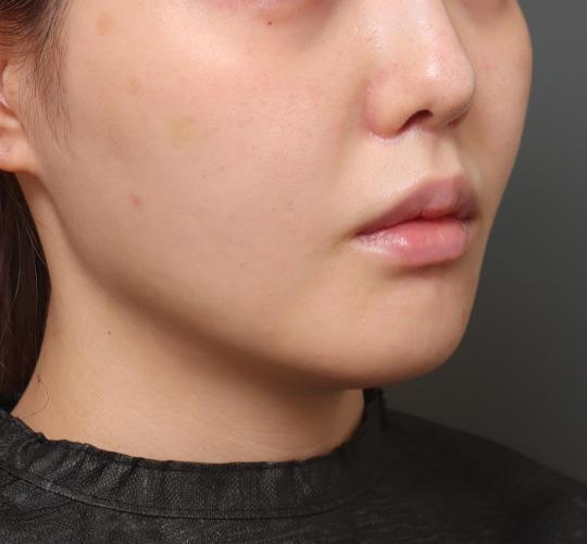 20代女性の人中短縮(リップリフト) After 症例写真