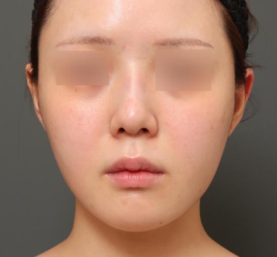 20代女性の人中短縮(リップリフト) Before 症例写真