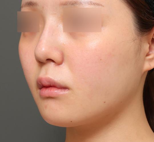 20代女性の人中短縮(リップリフト) Before 症例写真