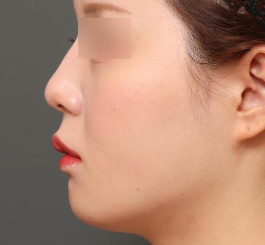 20代女性の人中短縮(リップリフト) Before 症例写真