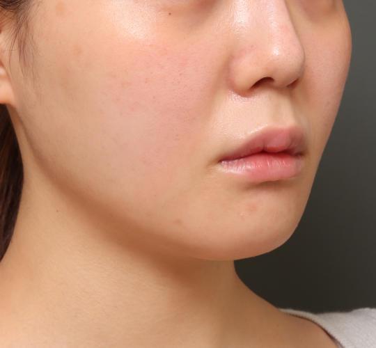 20代女性の人中短縮(リップリフト) Before 症例写真