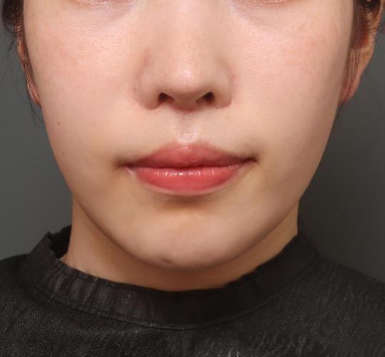 20代女性の人中短縮(リップリフト) After 症例写真