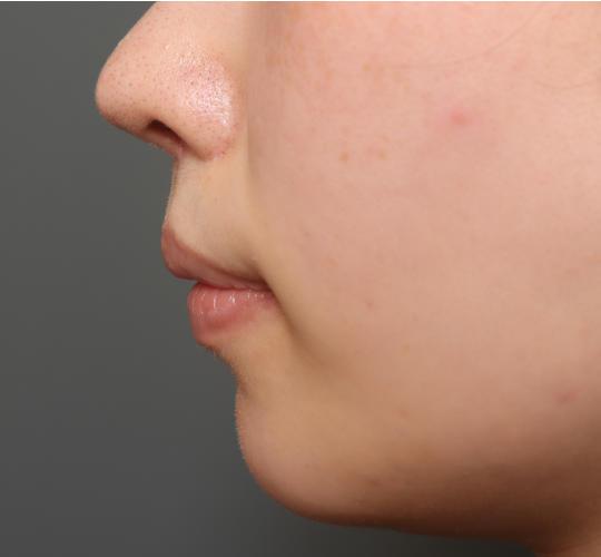 20代女性の人中短縮（リップリフト） After 症例写真