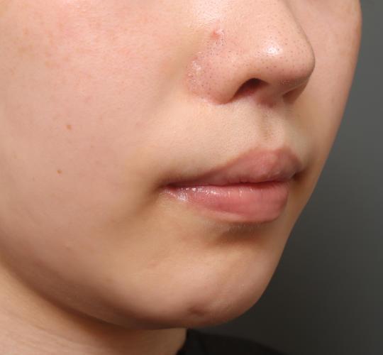 20代女性の人中短縮（リップリフト） After 症例写真
