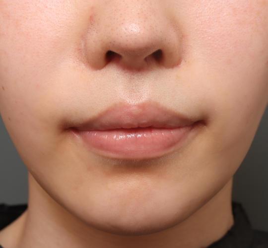 20代女性の人中短縮（リップリフト） After 症例写真