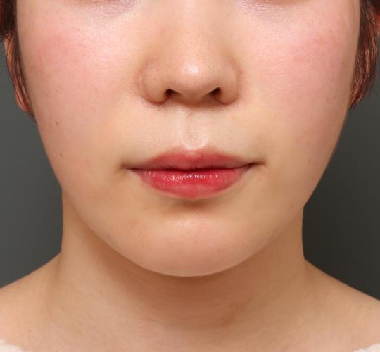 20代女性の人中短縮(リップリフト) Before 症例写真